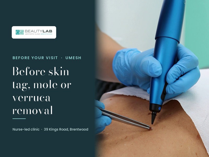 Before Skin Tag, Mole or Verruca Removal: What to Expect