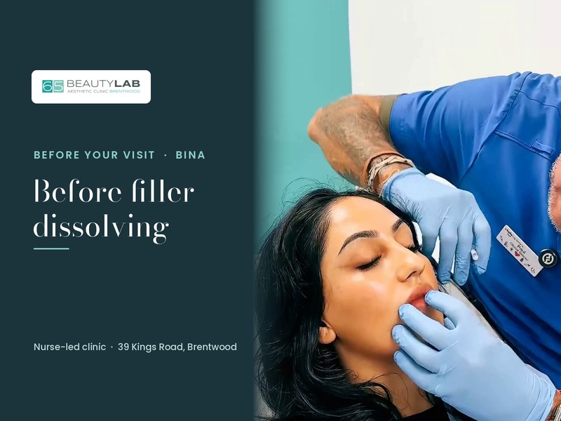Before Filler Dissolving: What Happens at Your Appointment