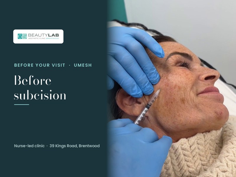 Before Subcision for Acne Scars: How to Prepare and What to Expect