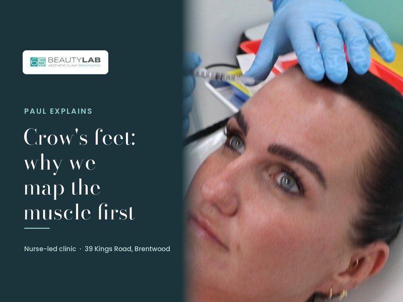 Crow's Feet: Why We Map the Muscle First. Paul Explains Anti-Wrinkle Treatment in Brentwood