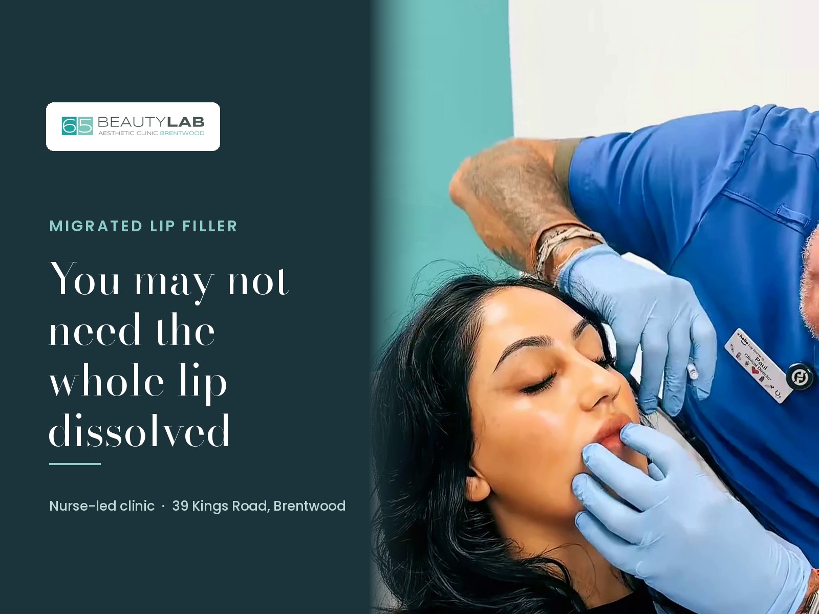 Migrated Lip Filler in Brentwood: Why You May Not Need the Whole Lip Dissolved