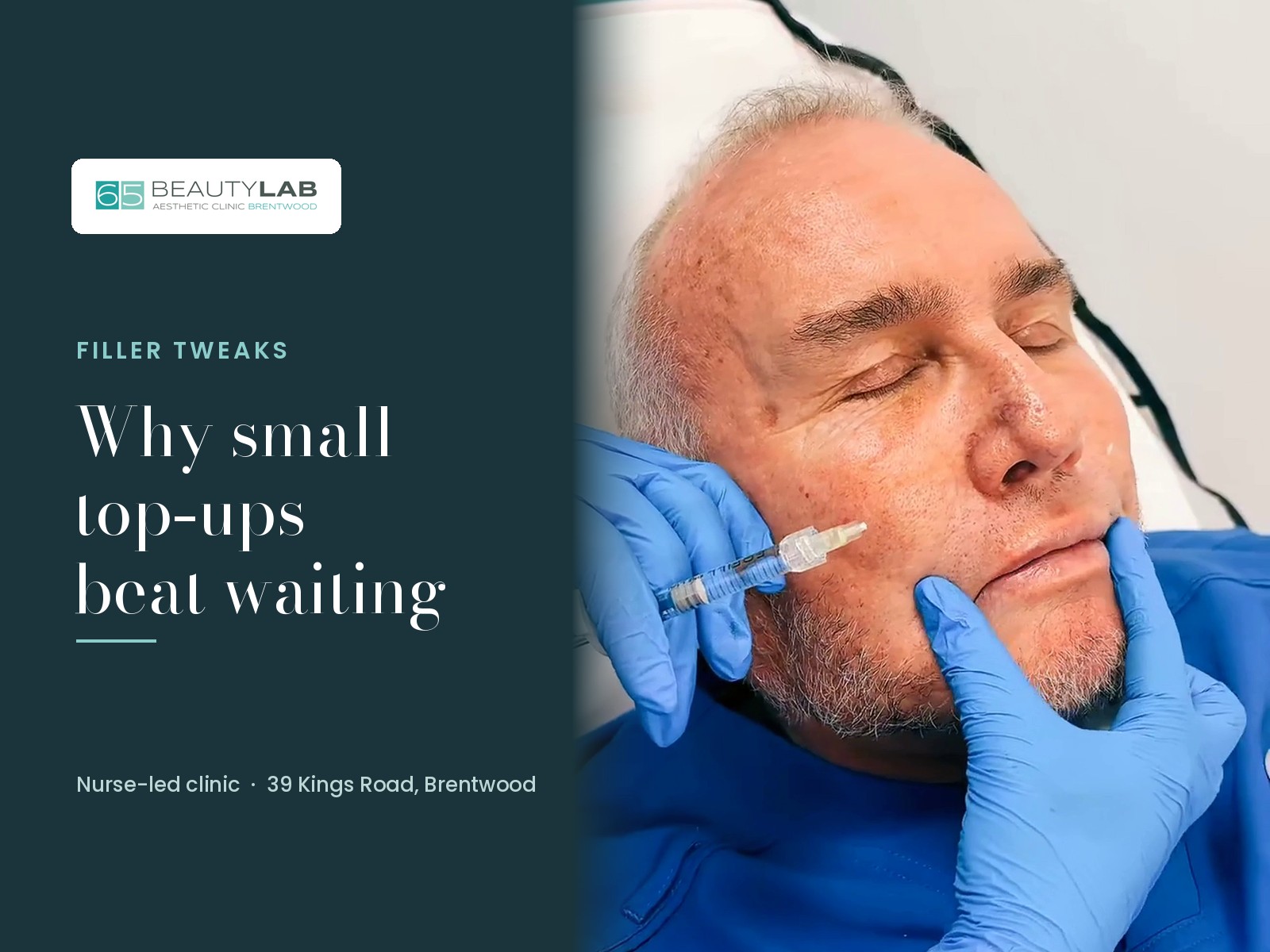 Filler Tweaks in Brentwood: Why Small Top-Ups Beat Waiting for It to Wear Off