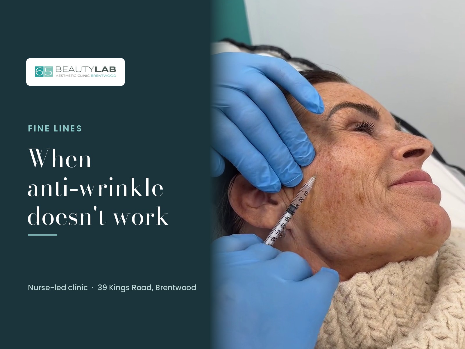 When Anti-Wrinkle Doesn't Work: Fine-Line Filler Explained at Our Brentwood Clinic
