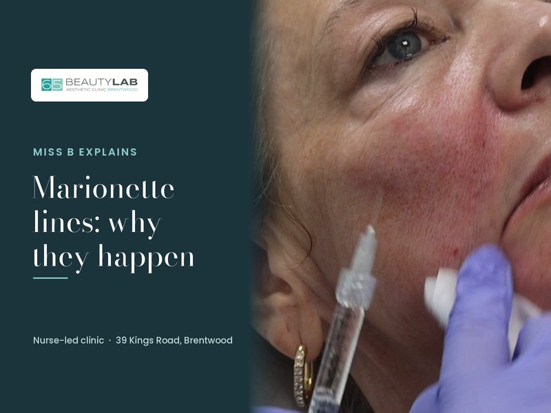 Marionette Lines: Why They Happen and What Can Help, at Our Brentwood Clinic