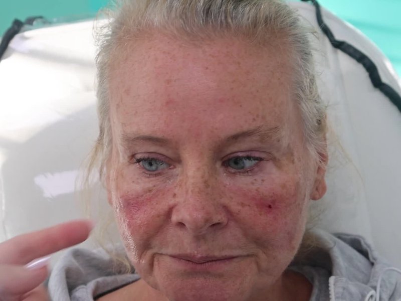 PCL Under-Eye Booster Start to Finish: Watch a Real Treatment for Hollows