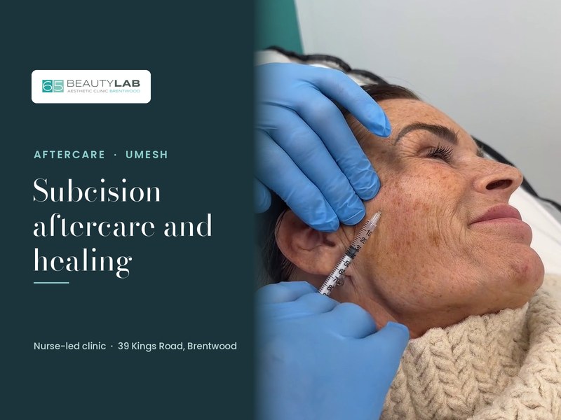 Subcision for Acne Scars: Aftercare and Healing Timeline
