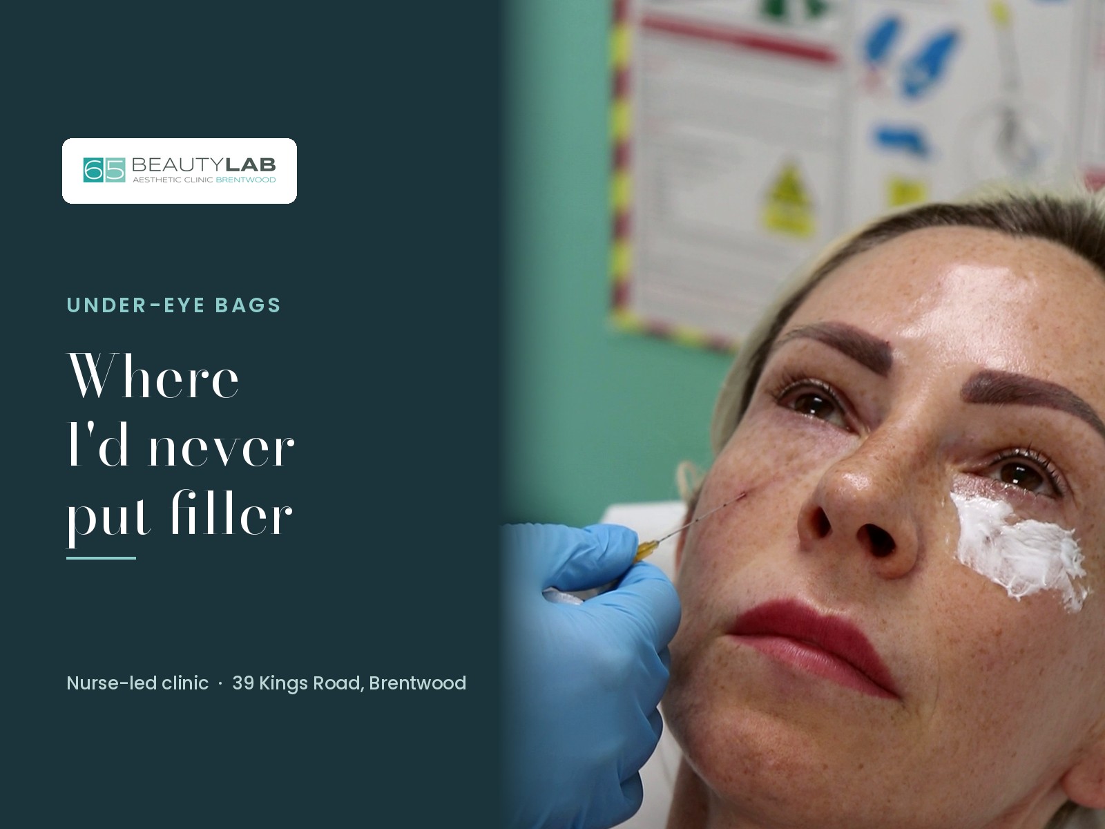 Under-Eye Bags in Brentwood: Why Our Clinical Director Would Never Reach for Filler First